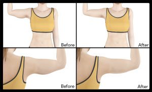 Arm lift