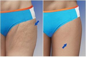 Thigh lift